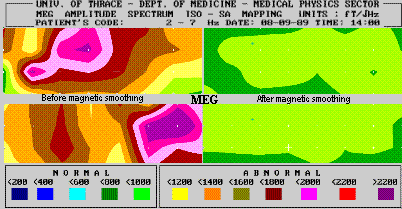 EMG mapping before and after magnetic smoothing